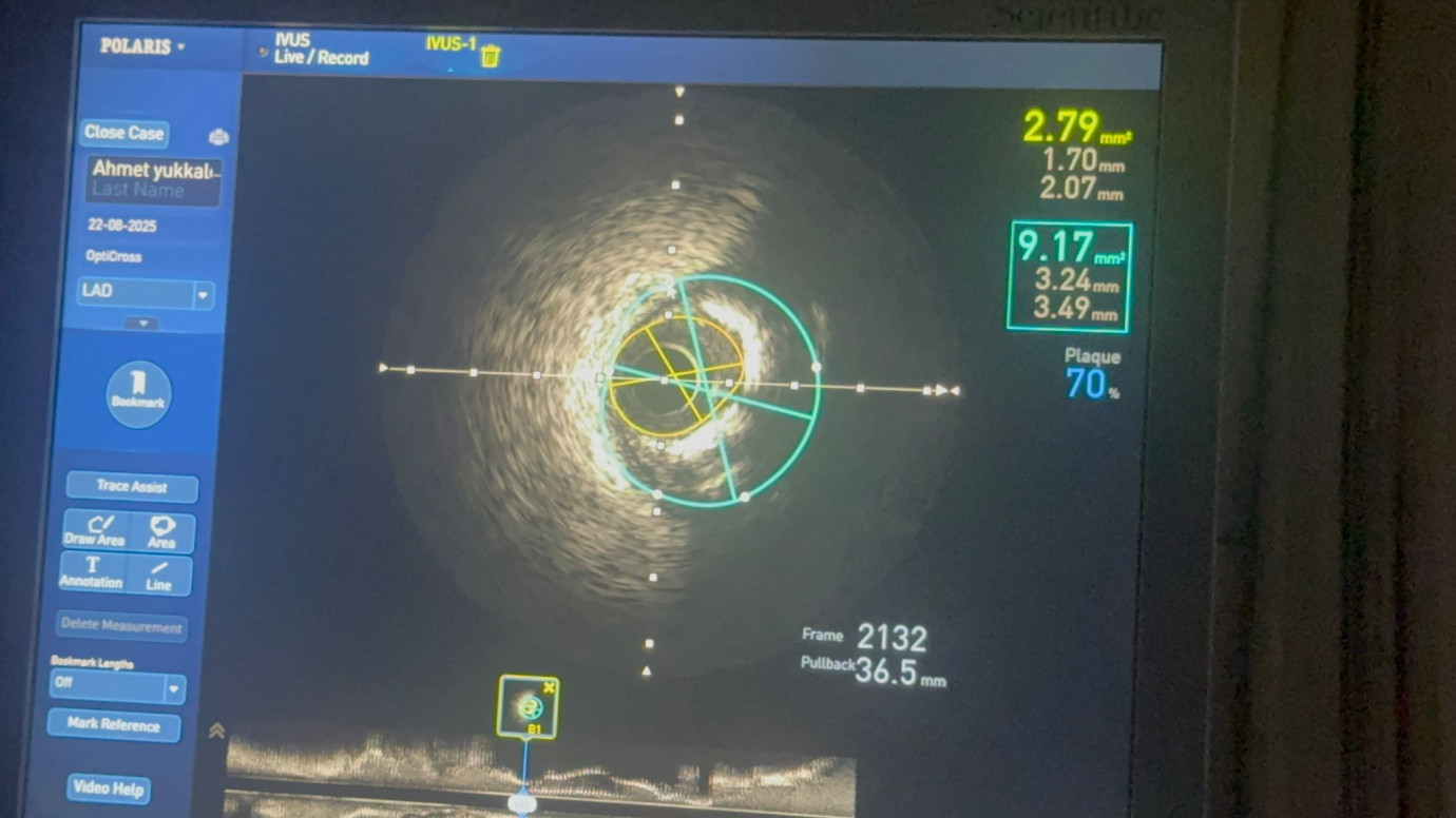 Şanlıurfa’da Kardiyoloji Alanında Bir İlk: IVUS Yöntemi ile Stent Uygulaması