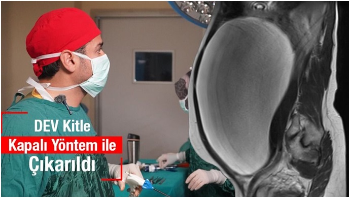 Dev Kitle Başarıyla Alındı: 47 Yaşındaki Kadın Sağlığına Kavuştu
