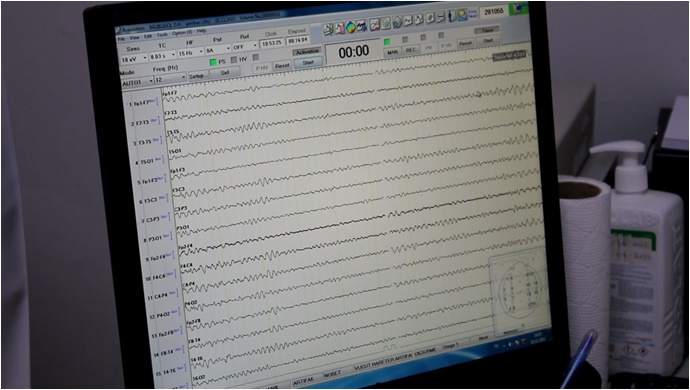 Epilepsi (Sara Hastalığı) Nasıl Anlaşılır